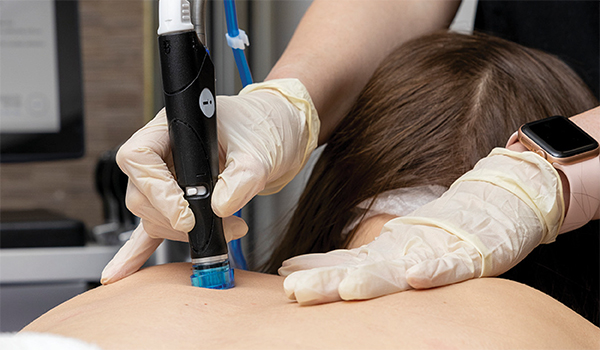 Curățarea spatelui cu Hydradermabraziune