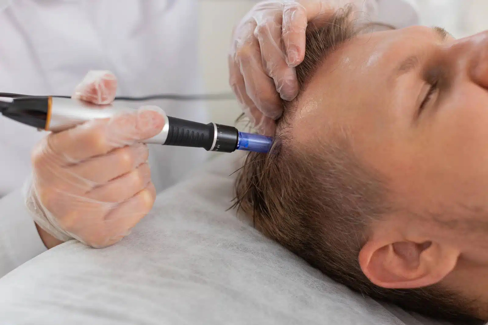 Microneedling cu exozomi pentru scalp